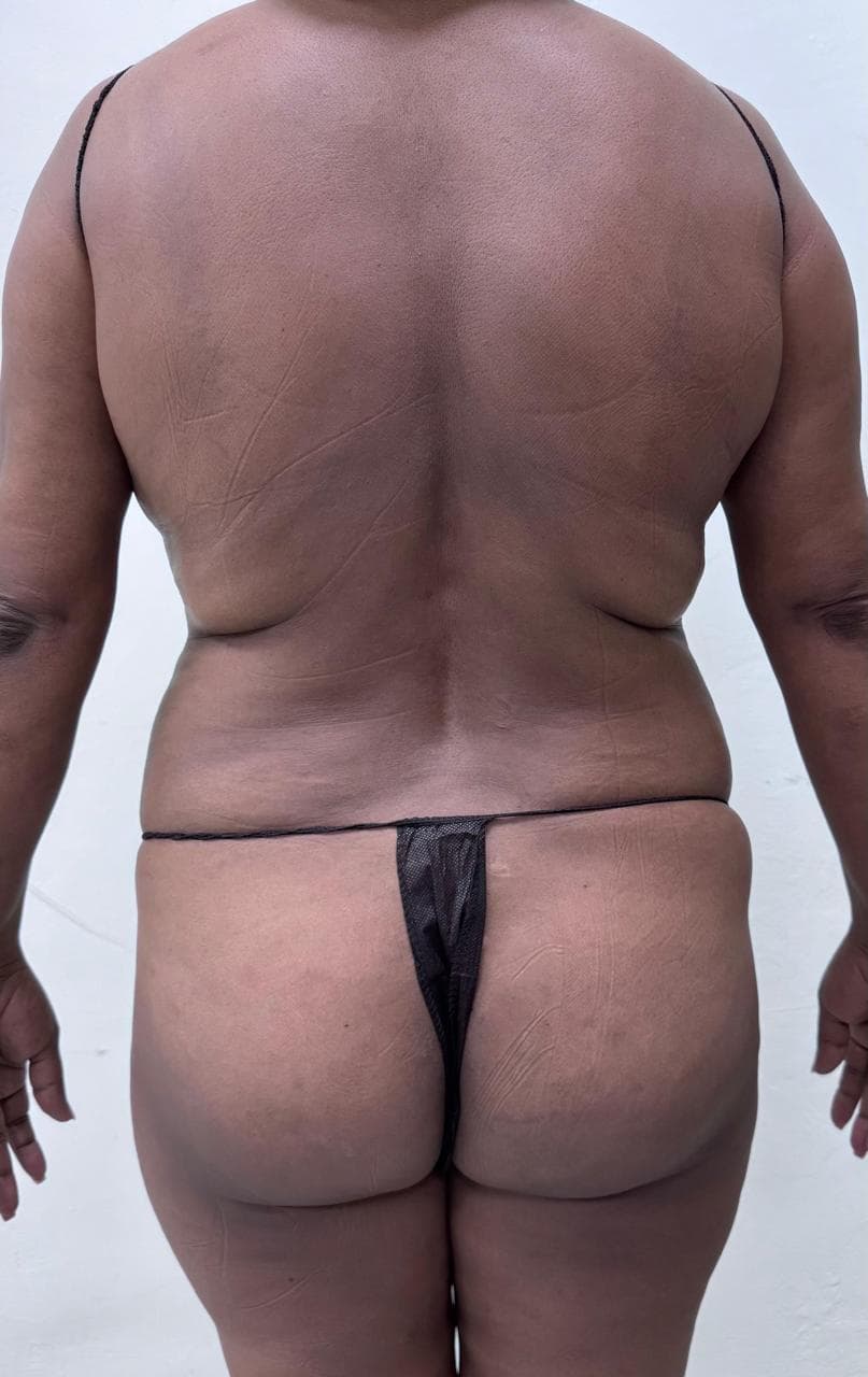Lipoescultura de Espalda - Resultado
