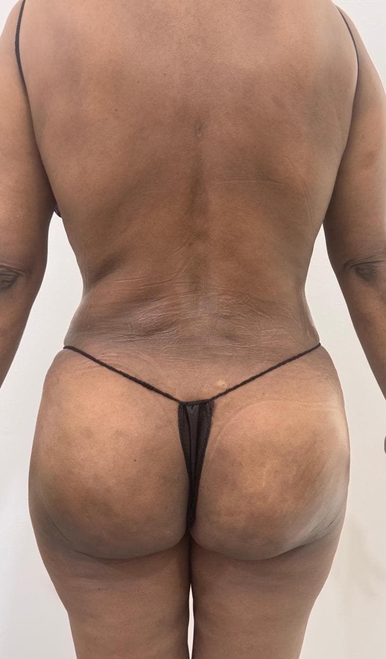 Lipoescultura de Espalda - Resultado