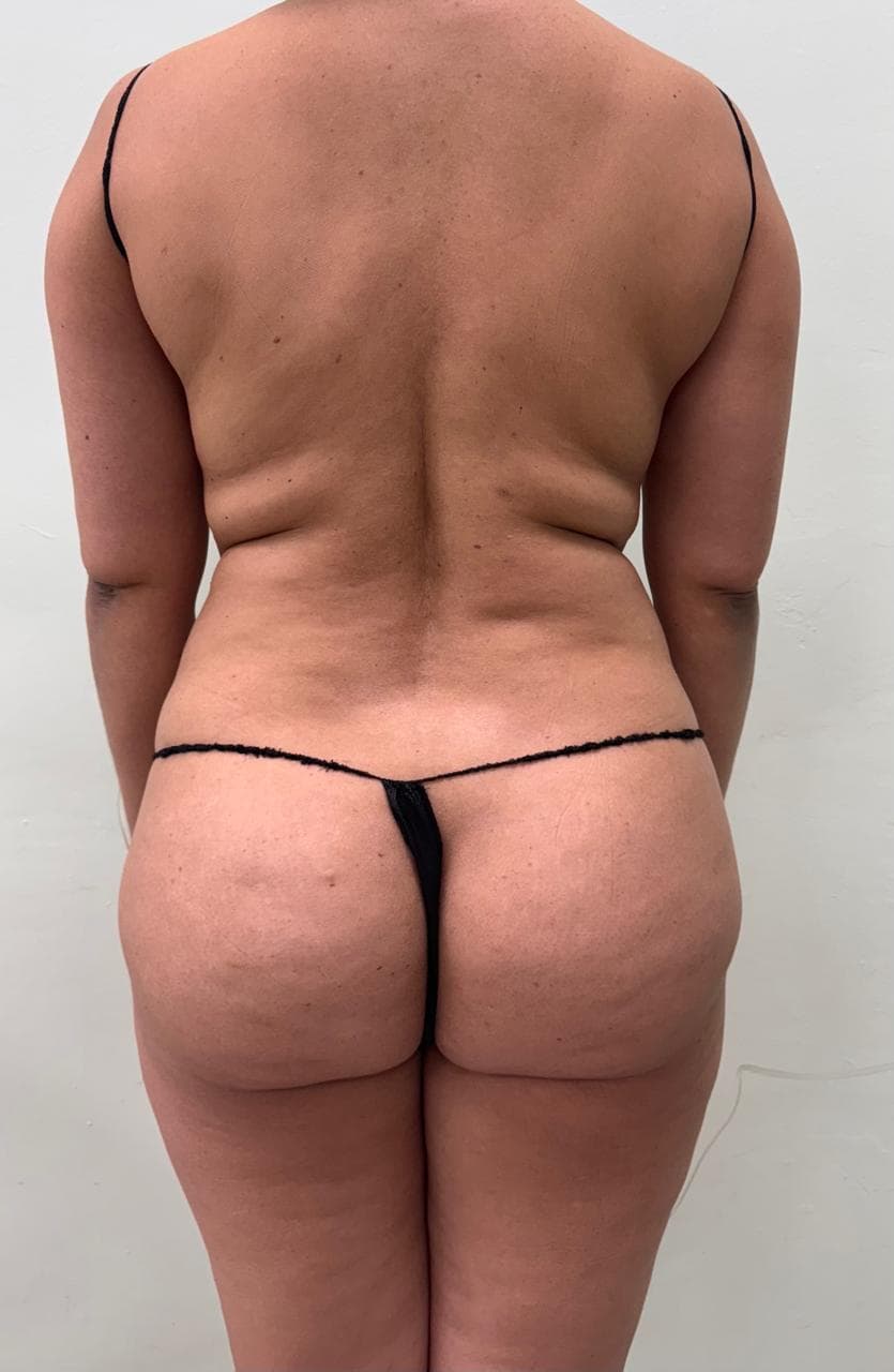 Lipoescultura de Espalda - Resultado