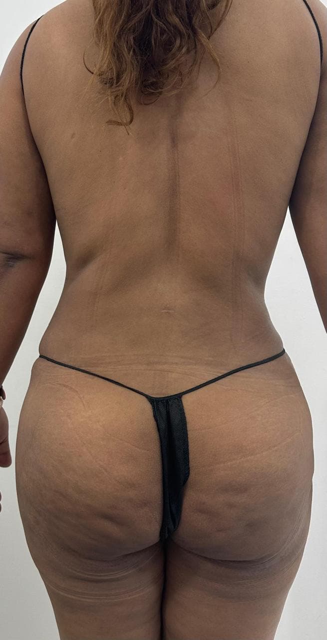 Lipoescultura de Espalda - Resultado