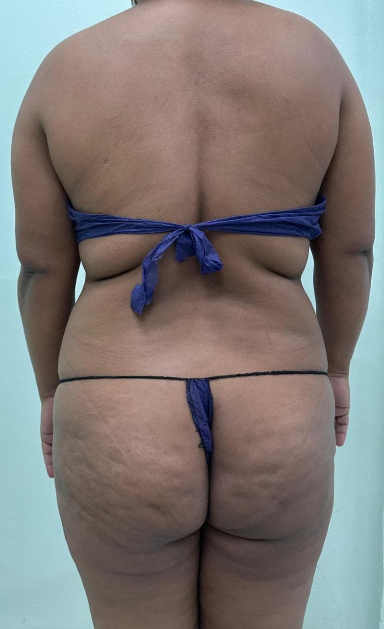 Lipoescultura de Espalda - Resultado