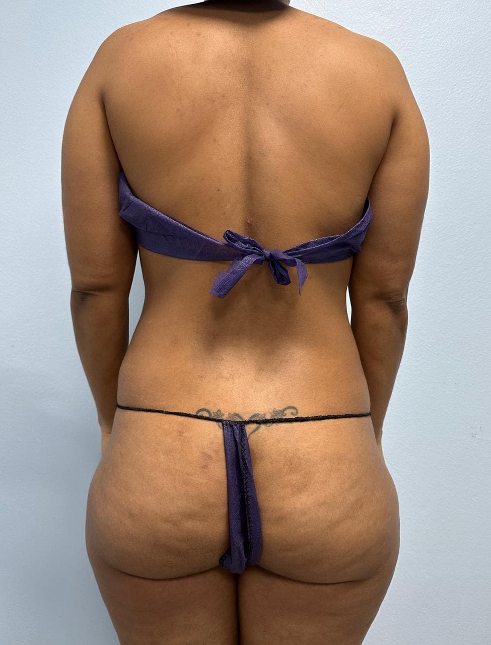 Lipoescultura de Espalda - Resultado