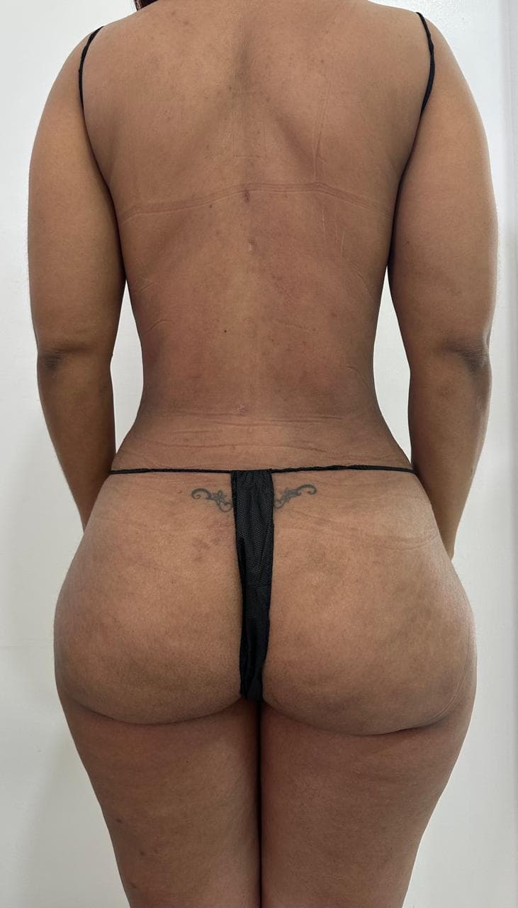 Lipoescultura de Espalda - Resultado