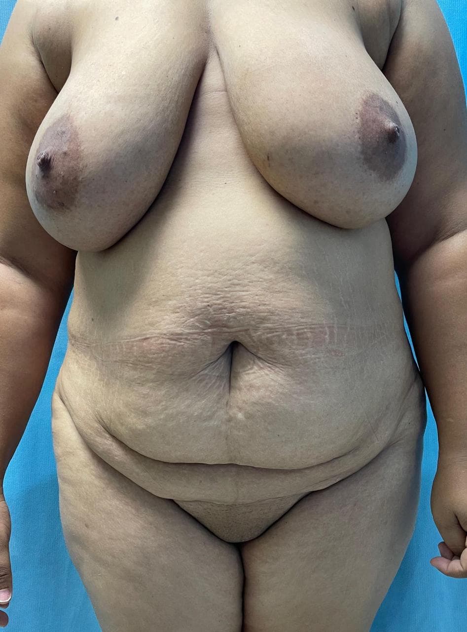 Mommy Makeover - Resultado