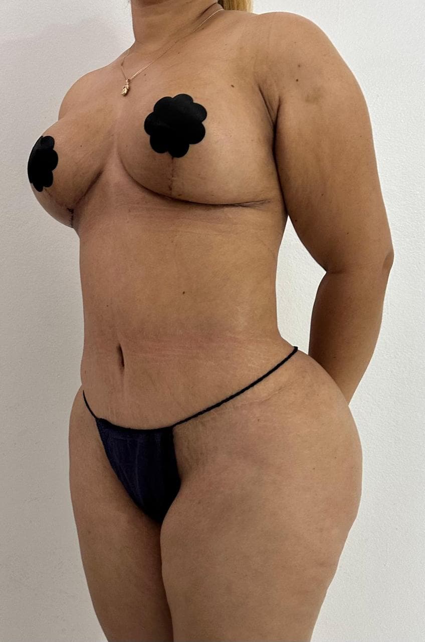 Mommy Makeover - Resultado