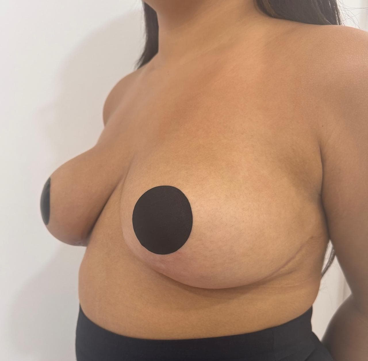 Mamoplastia de Reducción - Resultado
