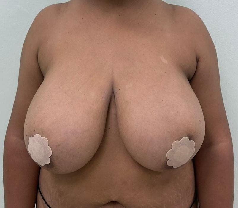 Mamoplastia de Reducción - Resultado
