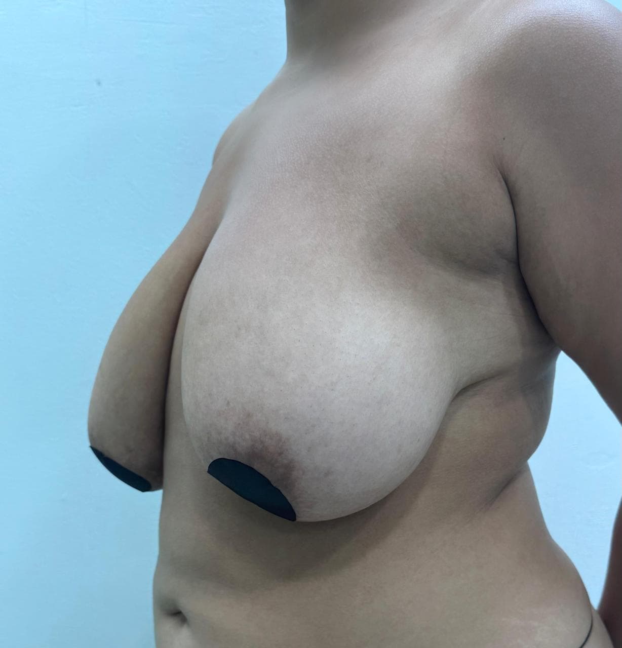 Mamoplastia de Reducción - Resultado