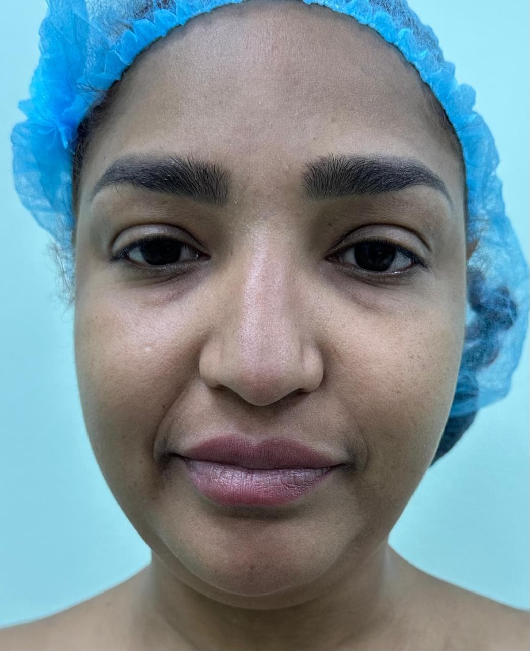 Rinoplastia - Resultado