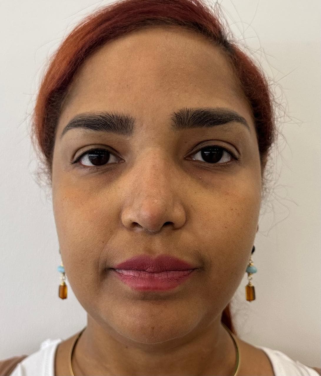 Rinoplastia - Resultado