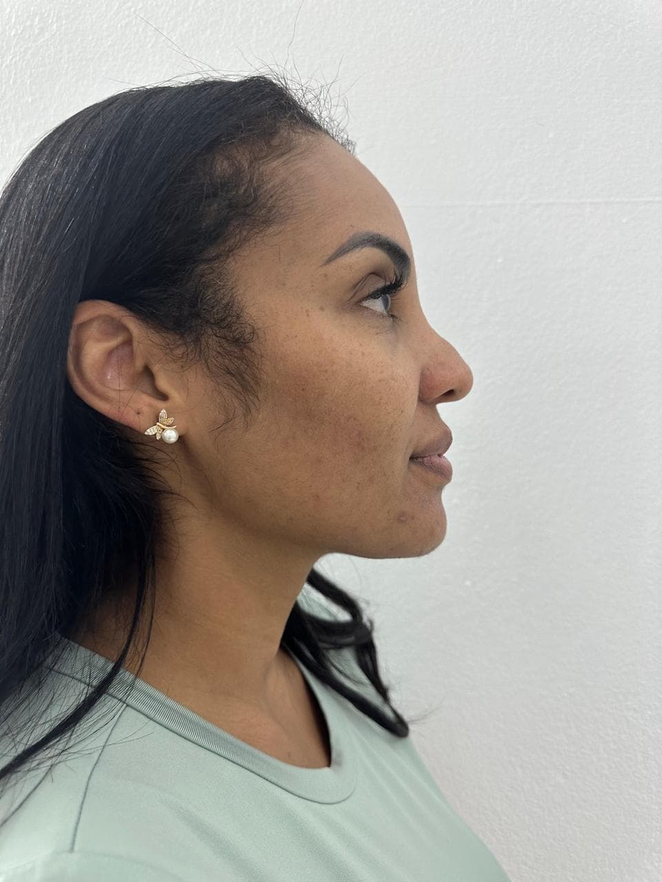 Rinoplastia - Resultado