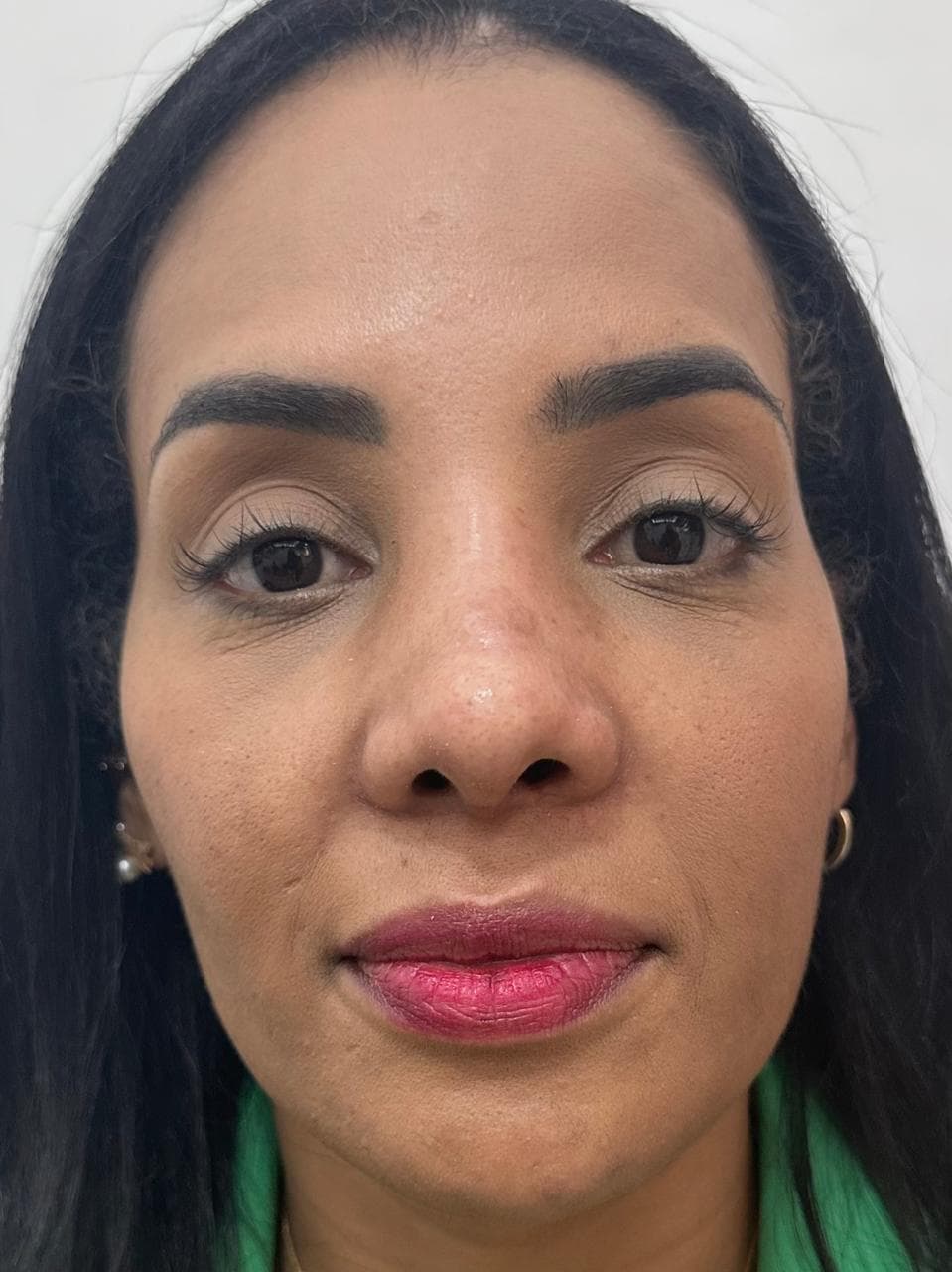 Rinoplastia - Resultado