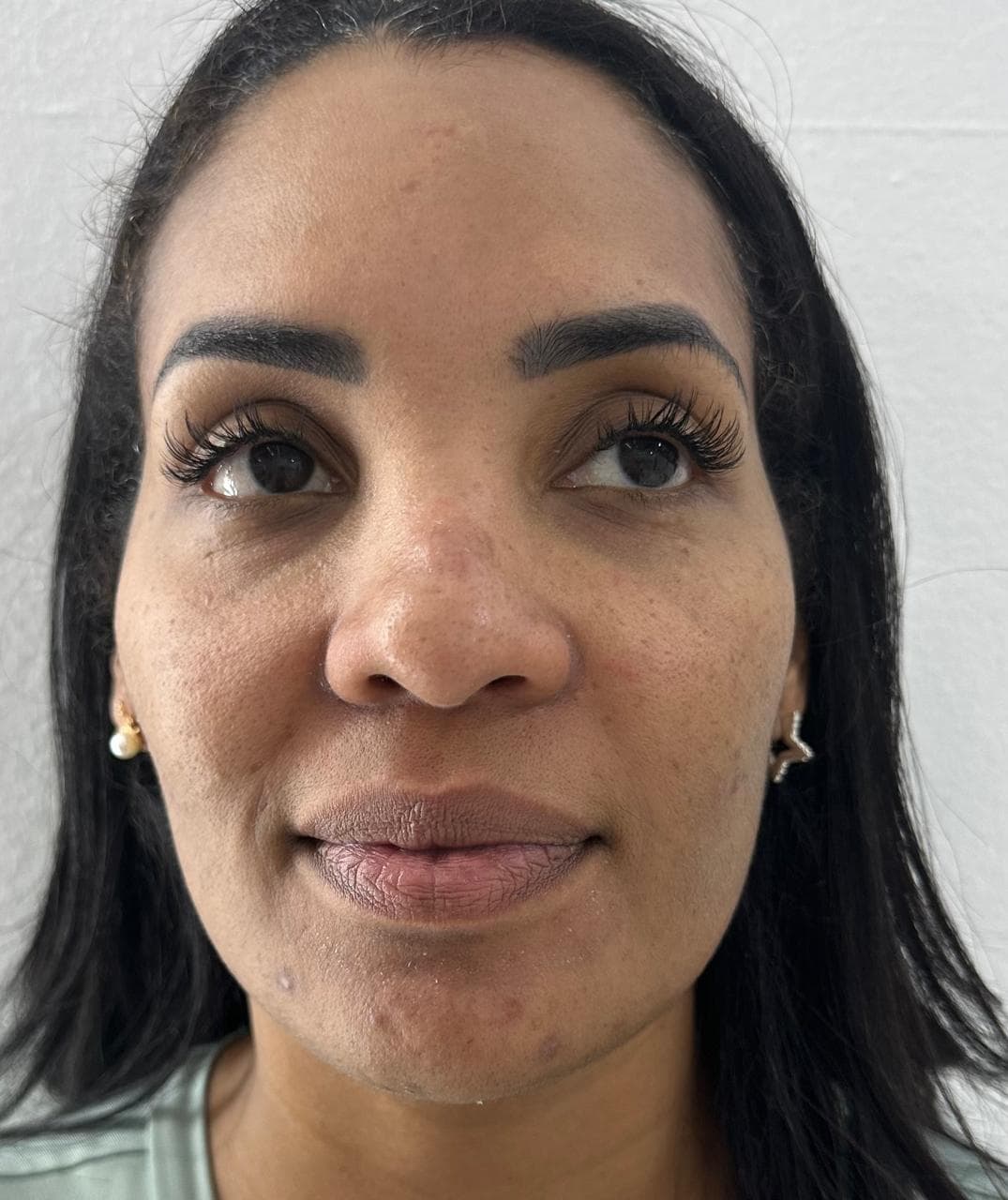 Rinoplastia - Resultado