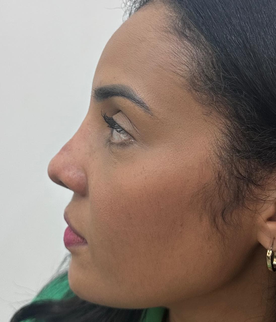 Rinoplastia - Resultado